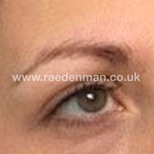 eyebrow medical tattoo before