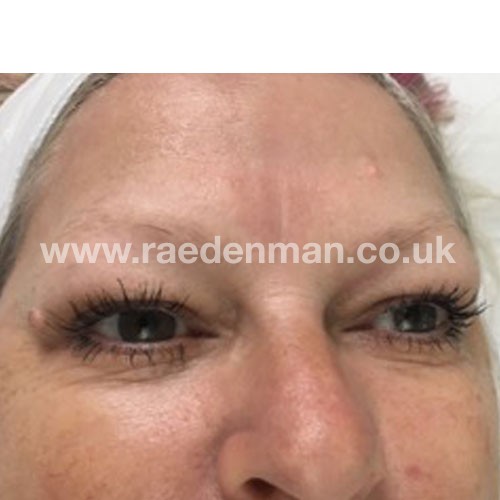 eyebrow medical tattoo before