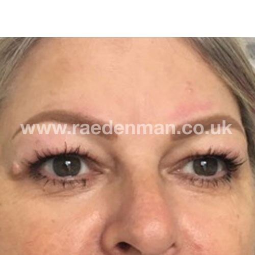eyebrow medical tattoo after