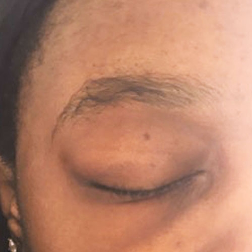 eyebrow medical tattoo before