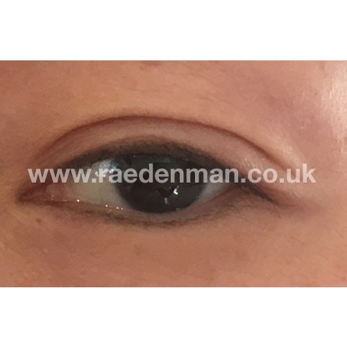 medical tattooing patchy lips before