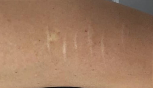 Self Harm Scarring Camouflage with Medical Tattooing
