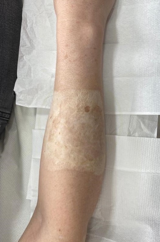 skin graft tattoo before