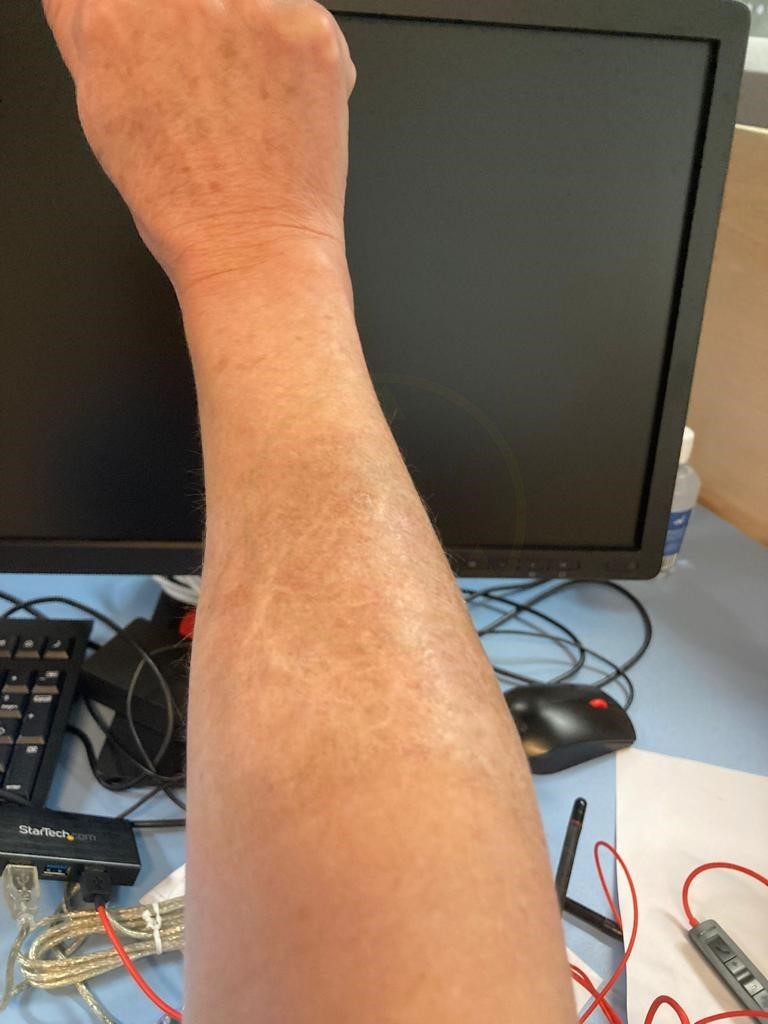 skin graft tattoo after