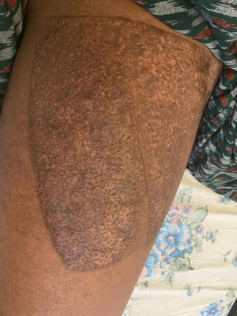 skin graft tattoo after