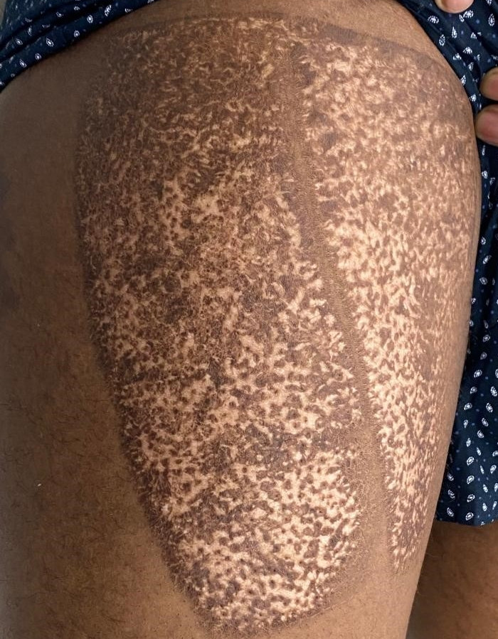 skin graft tattoo before