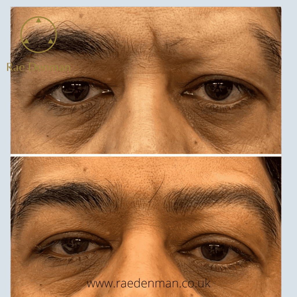 facial hairloss