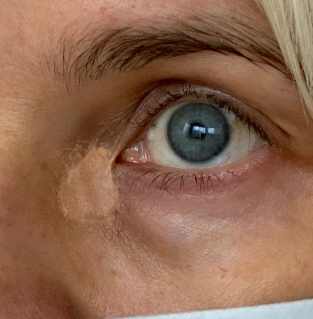 skin graft tattoo before