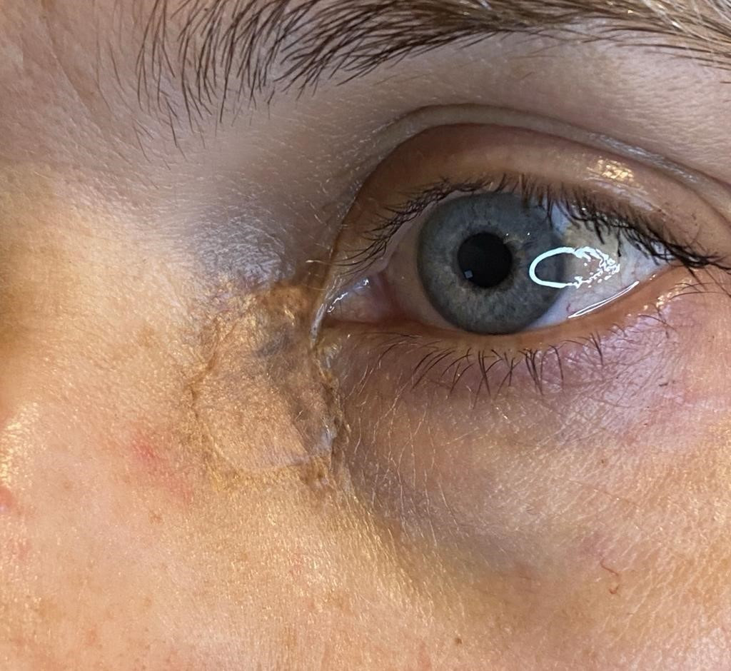 skin graft tattoo after