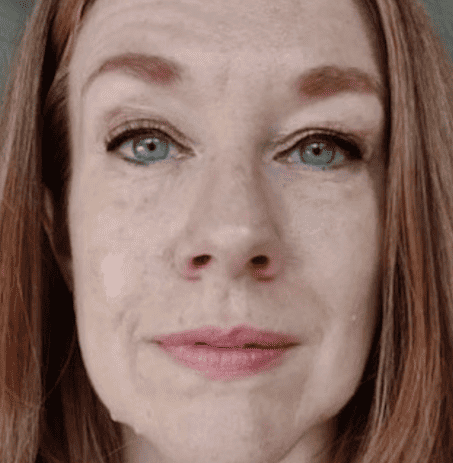 skin graft tattoo after