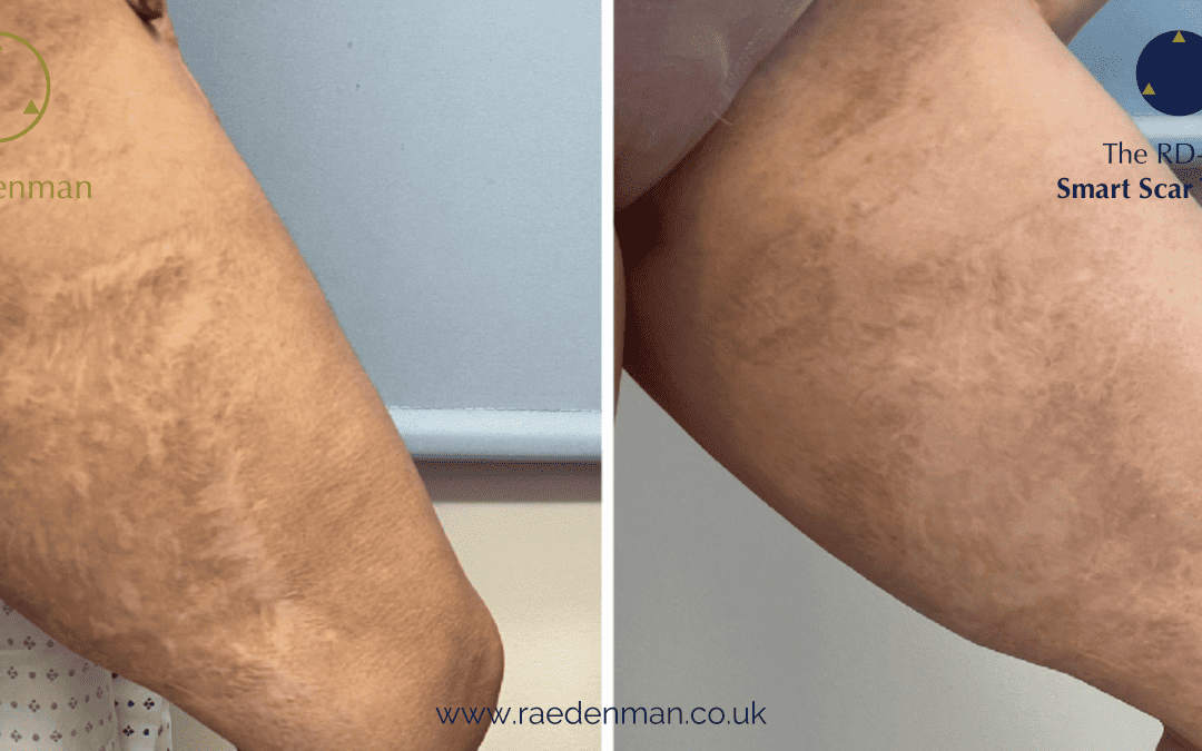 Medical Tattooing For Trauma Scarring