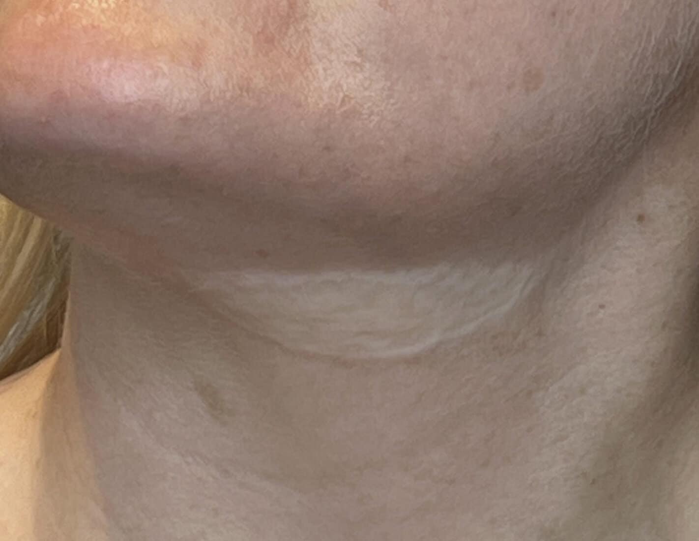 skin graft tattoo before