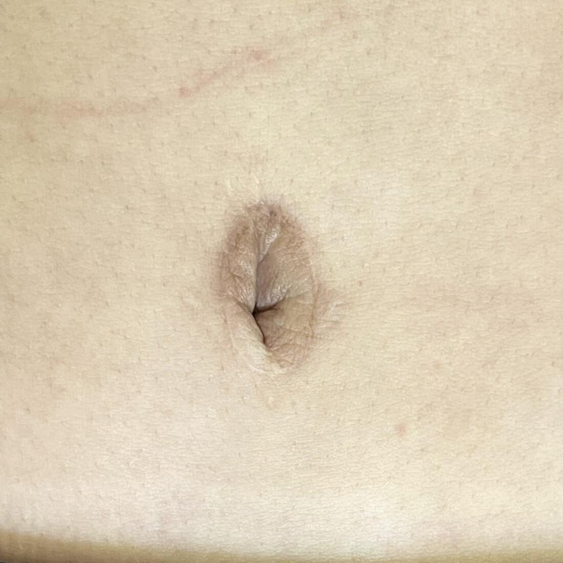 skin graft tattoo after