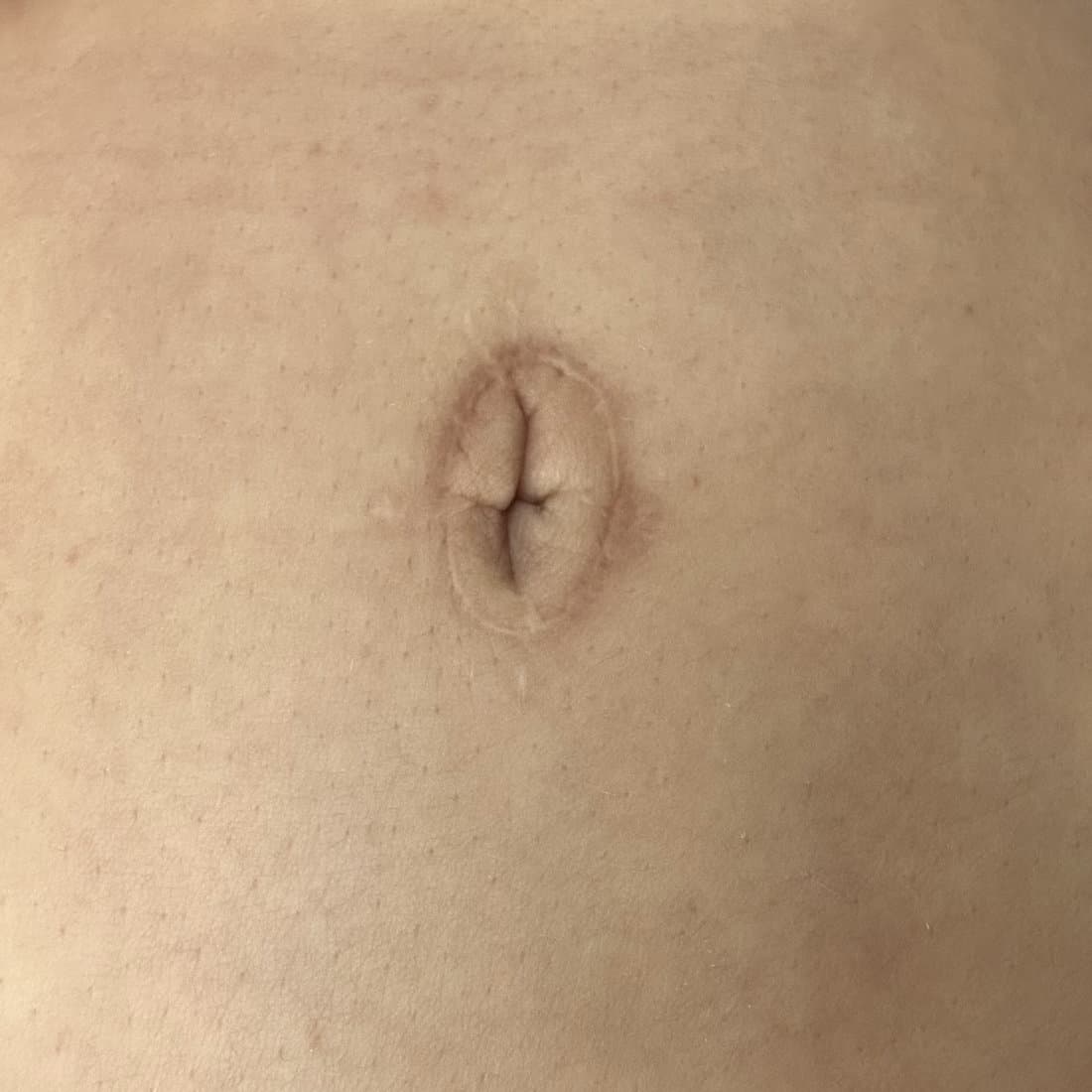 skin graft tattoo before