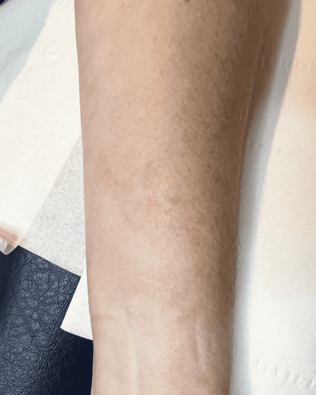 medical tattooing for scars after