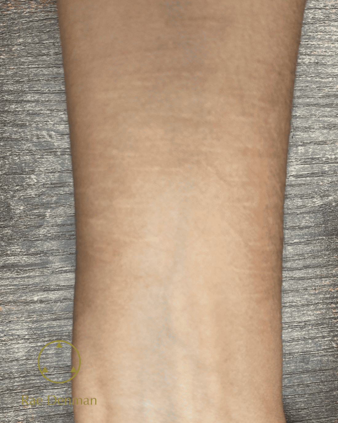 medical tattooing for scars after