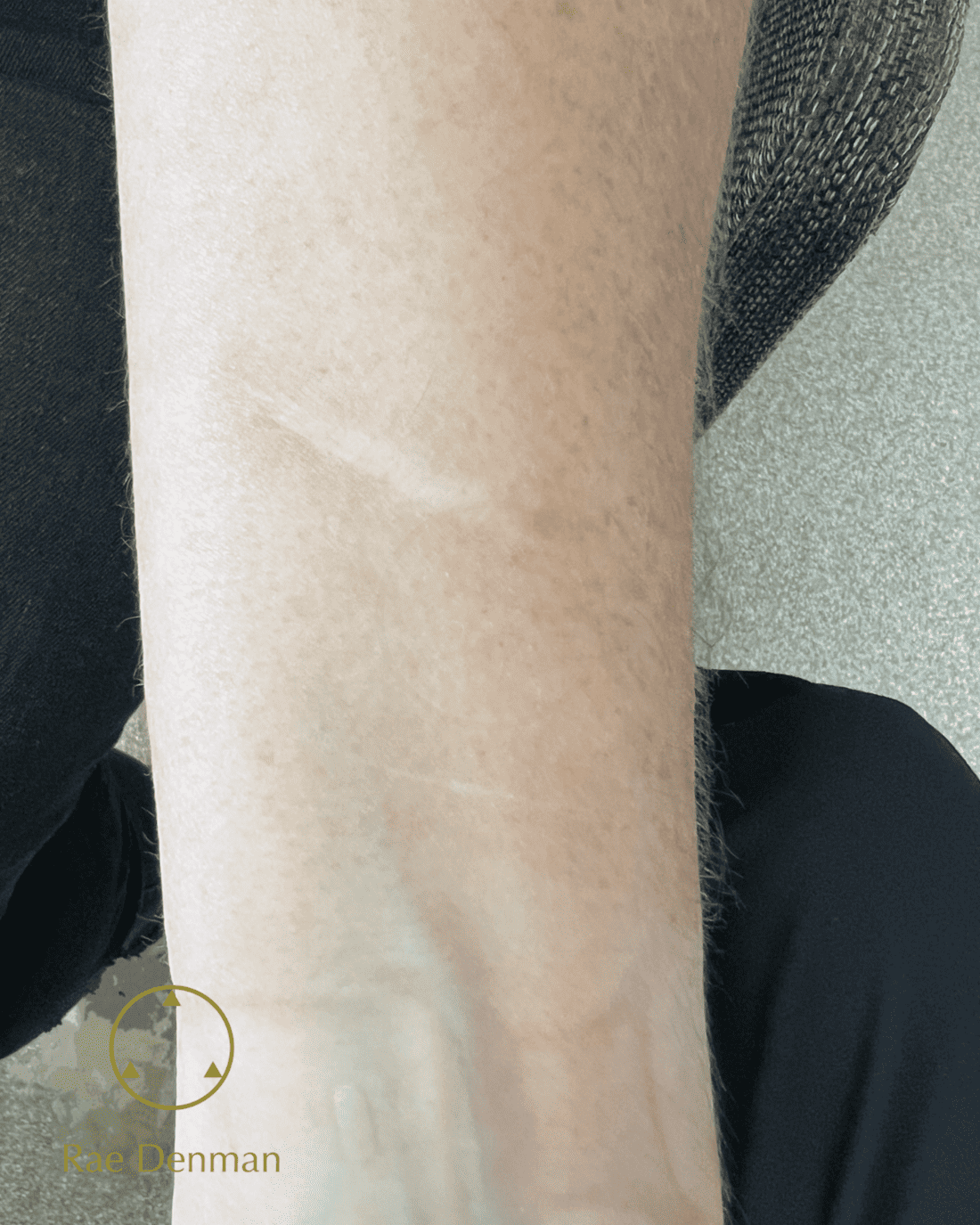 scar camouflage