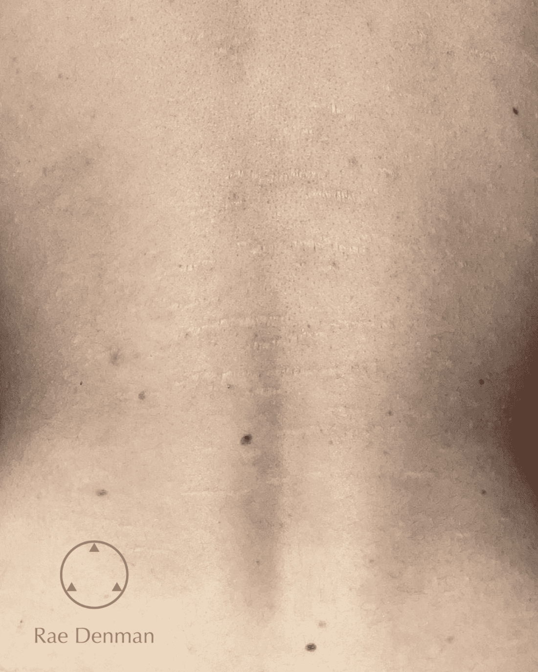 medical tattooing for scars after