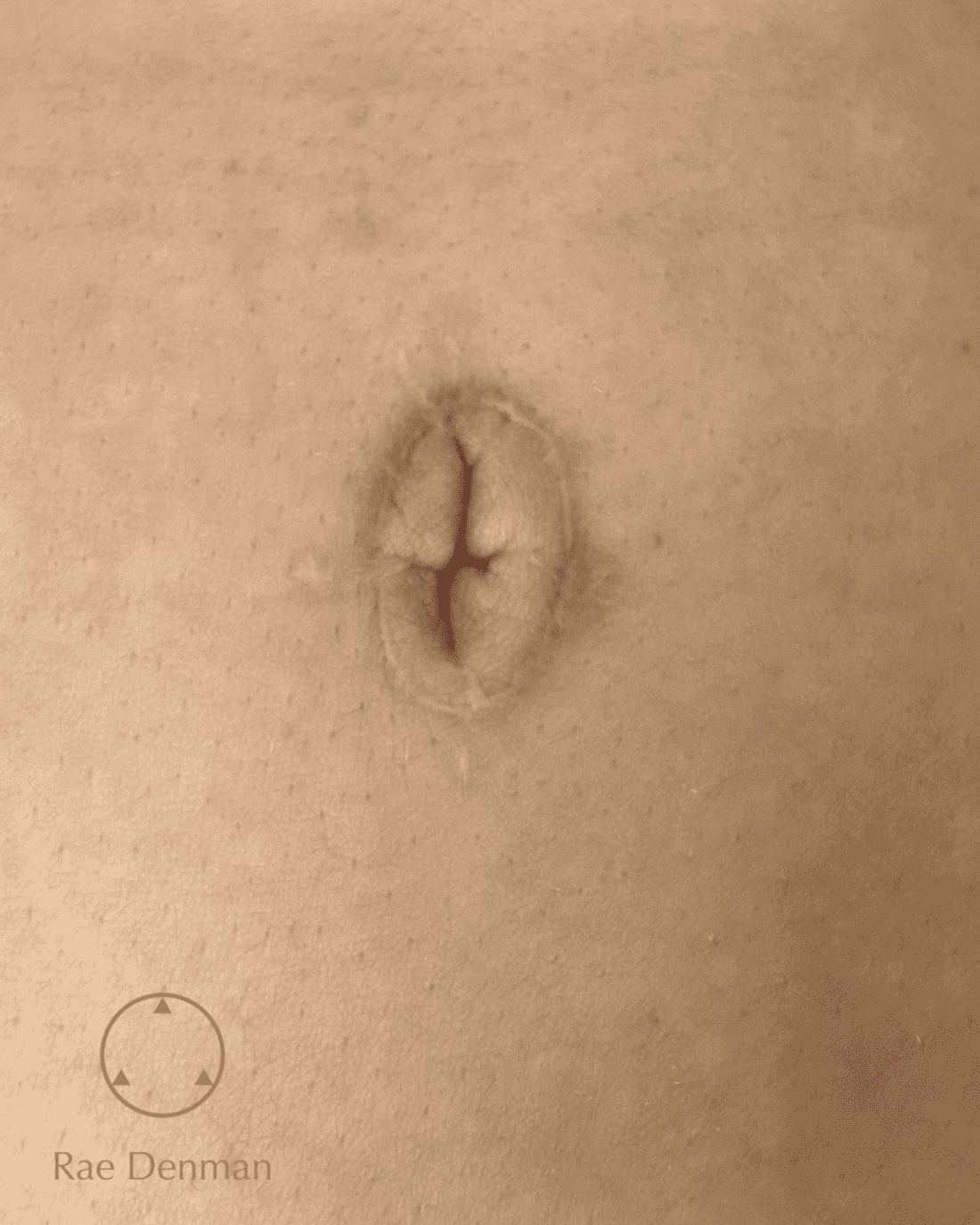 medical tattooing for scars before