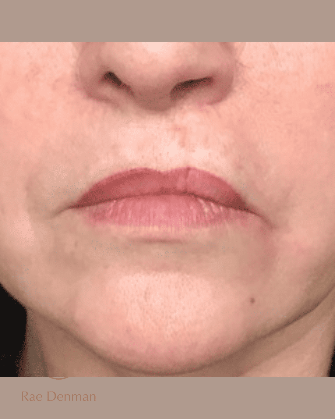 medical tattooing for scars after