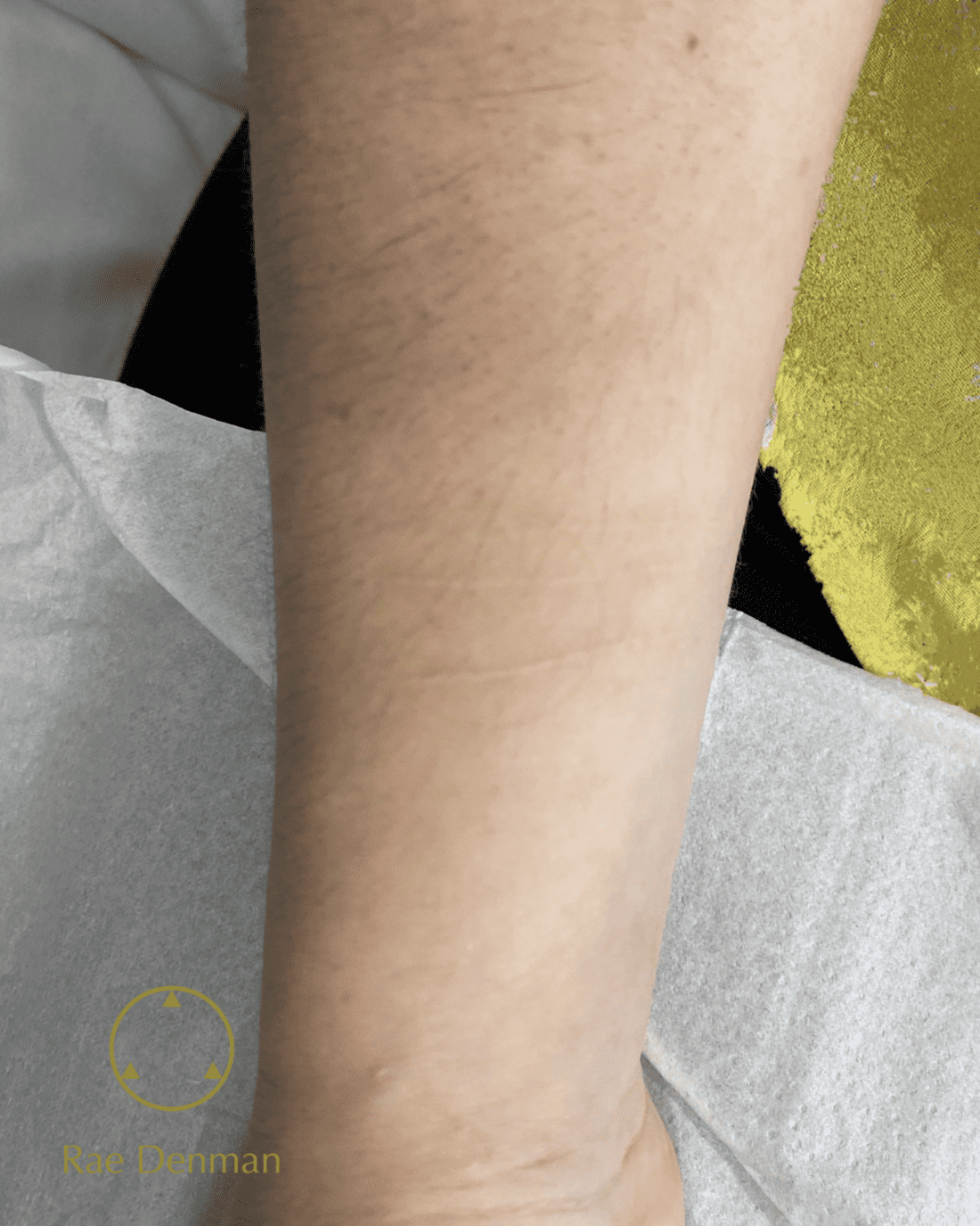 medical tattooing for scars after