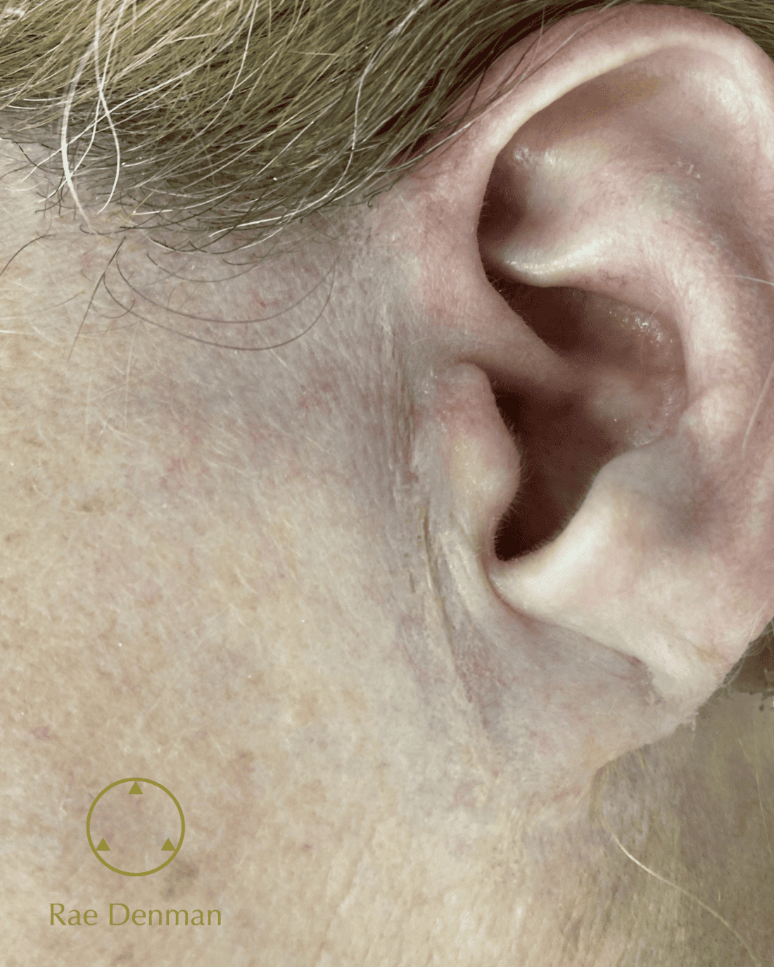 medical tattooing for scars after