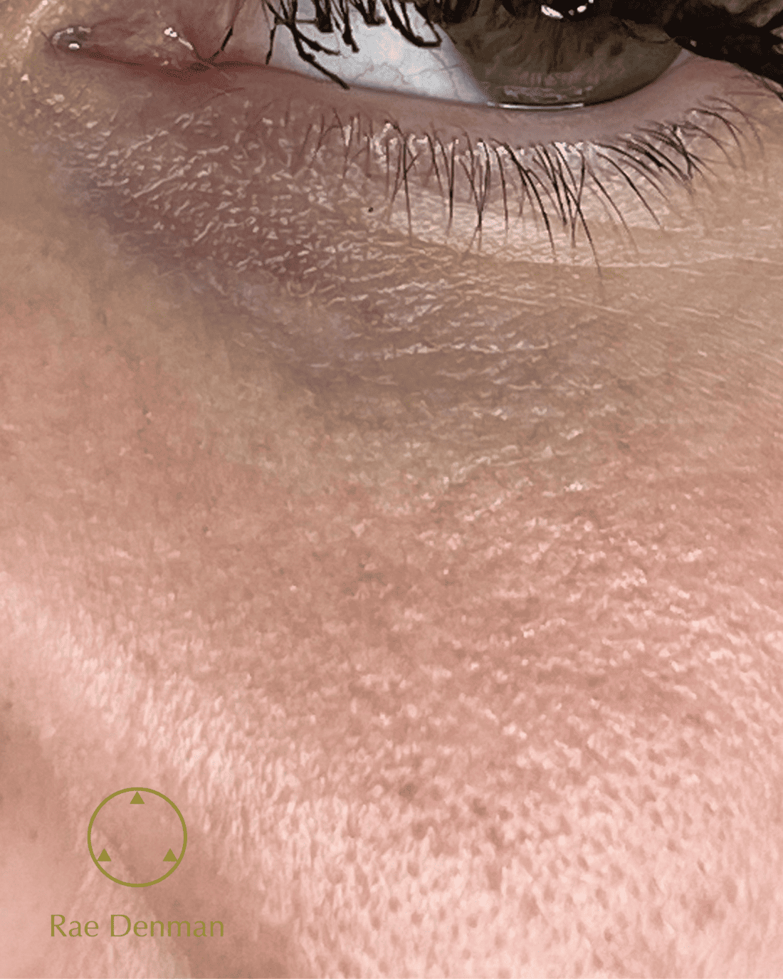 medical tattooing for scars after