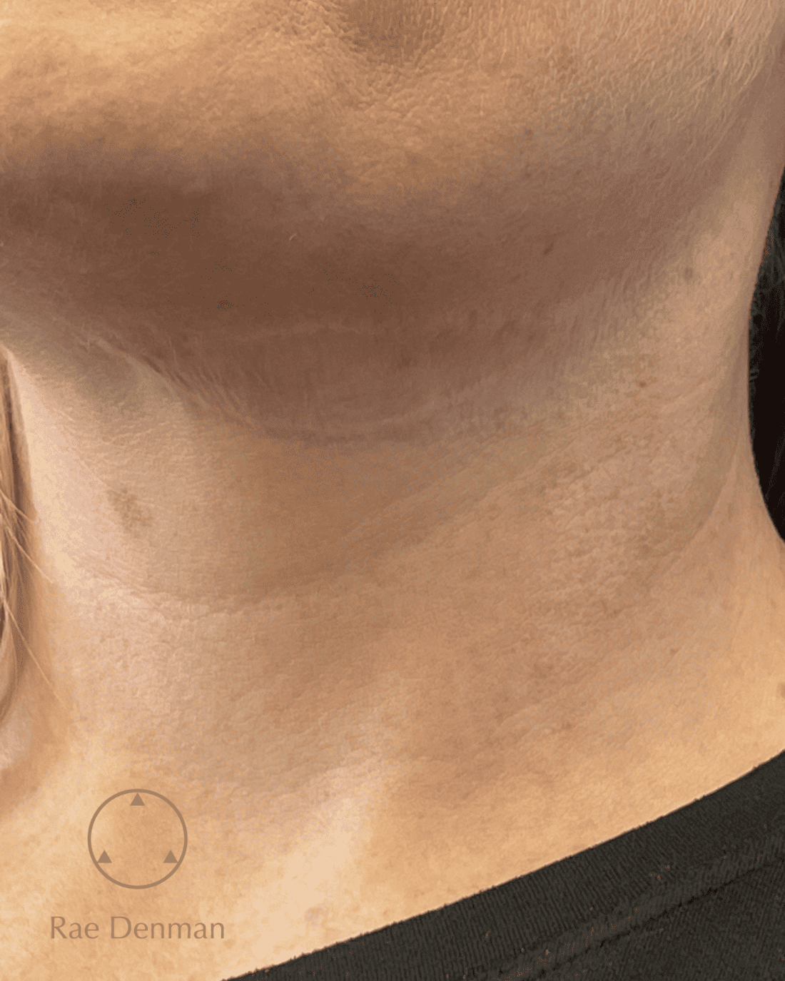 medical tattooing for scars after