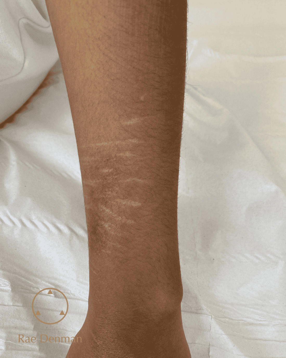 scar camouflage