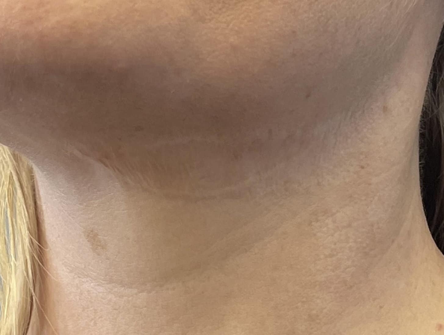 skin graft tattoo after