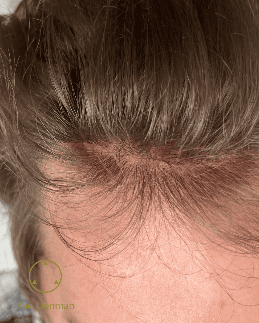 medical tattooing for scars after