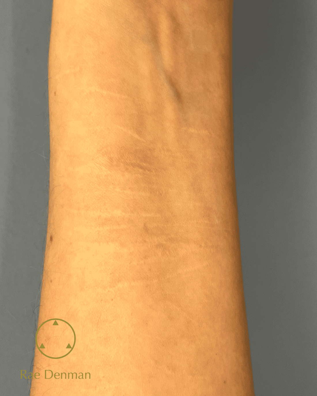 medical tattooing for scars after