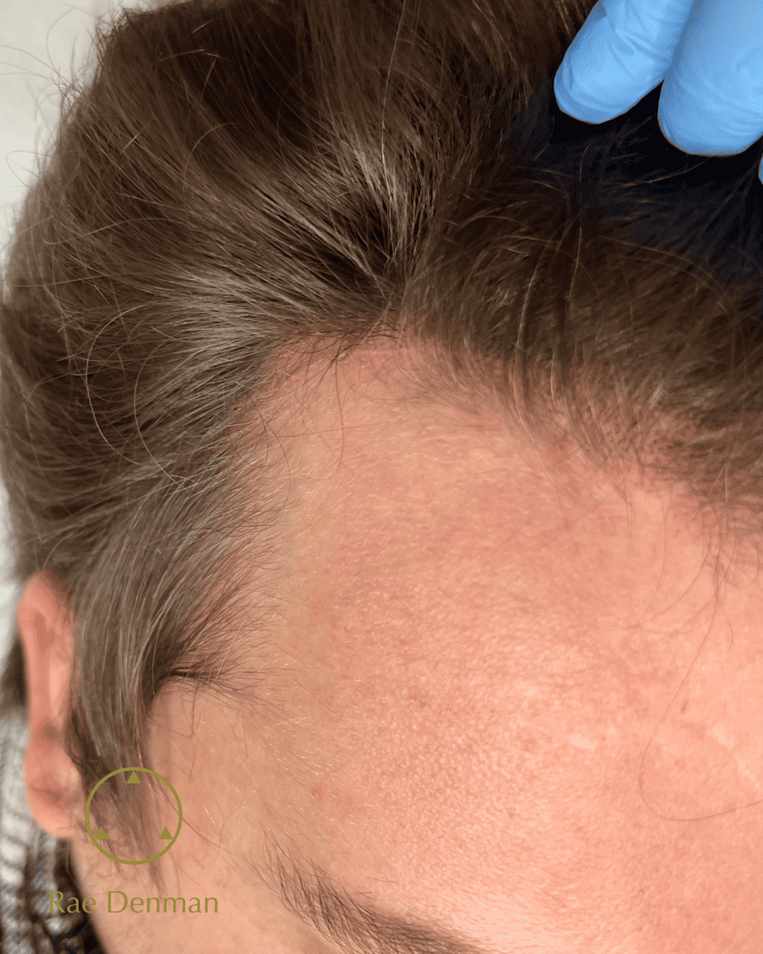 medical tattooing for scars after