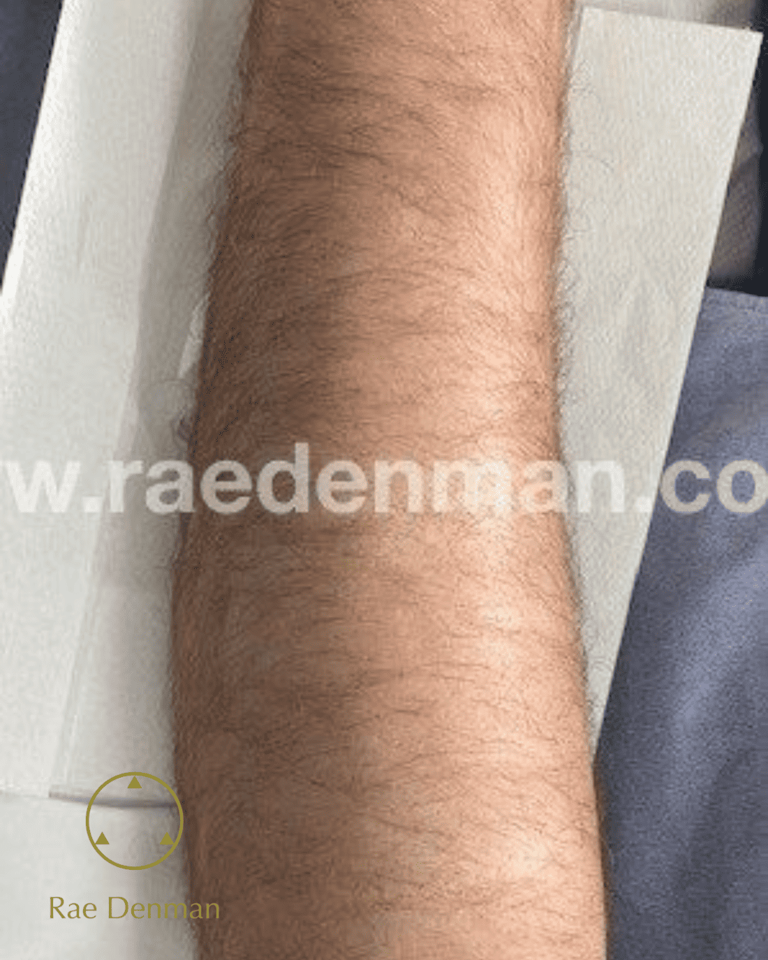 medical tattooing for scars after