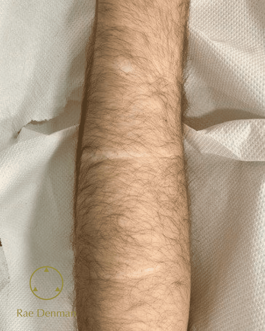 scar camouflage