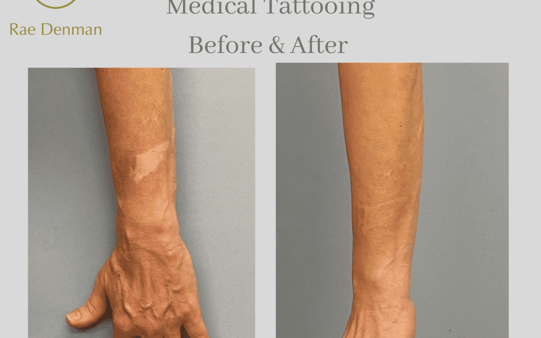 Hot Water Bottles: The Hidden Danger of Scalds and How Medical Tattooing Can Help