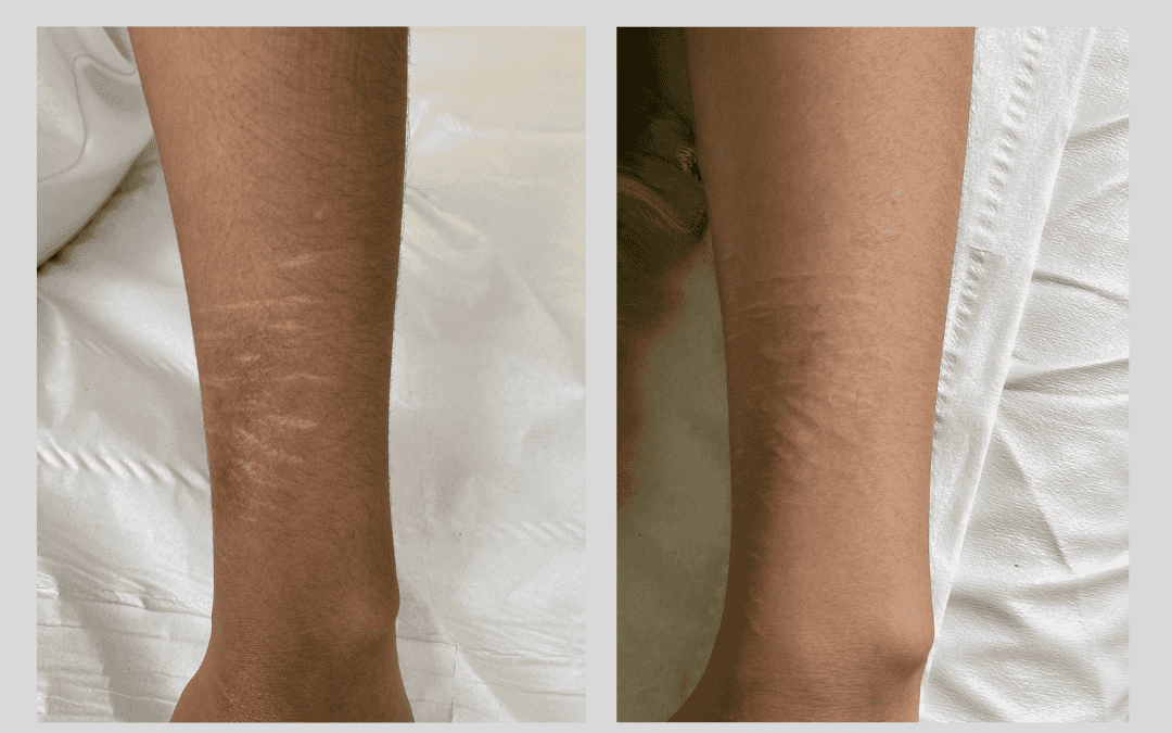 Fine Detailing: The Art and Precision of Medical Tattooing
