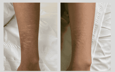 Fine Detailing: The Art and Precision of Medical Tattooing