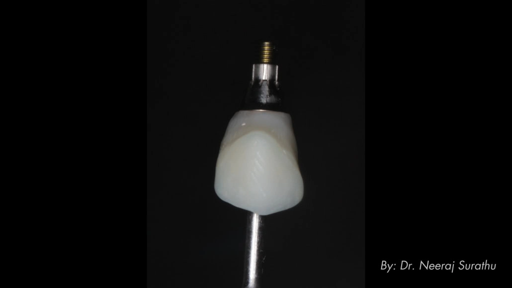 3D printed shell picked up using flowable composite and ready to deliver day of surgery