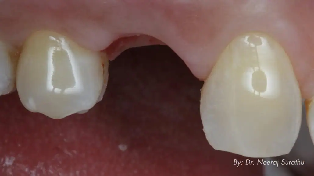 3-month post operation picture that shows healthy tissue with intact papillae allowing the dental professional to copy the tissue profile to proceed with the final restoration