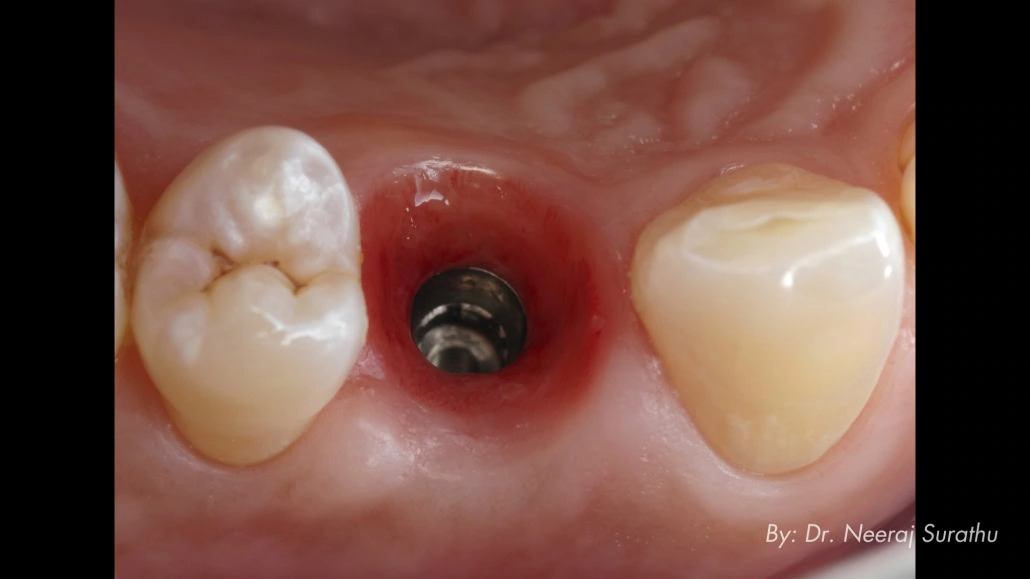 Picture that shows how well the soft tissue maturation is going for a patient after using an immediate provisional in #5 (First bicuspid/premolar) for 3 months