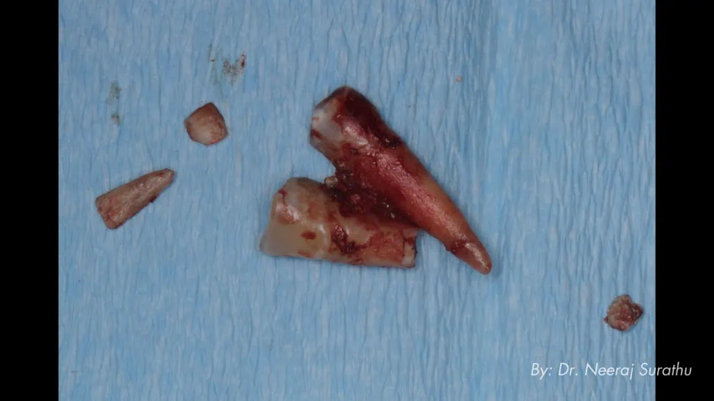 Image of an extracted #5 (First bicuspid/premolar)