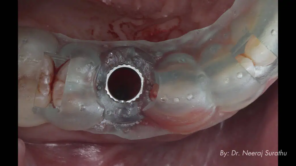3D printed surgical guide in place to guide implant placement in #5 (First bicuspid/premolar)