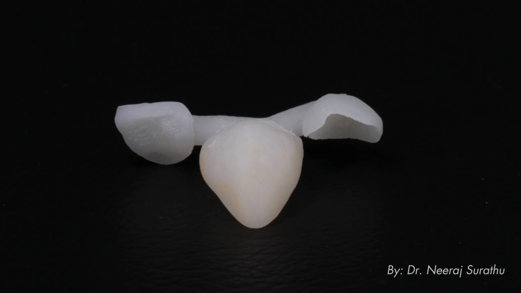 3D printed characterized shell provisional with vertical stop to guide intraoral chairside pick up