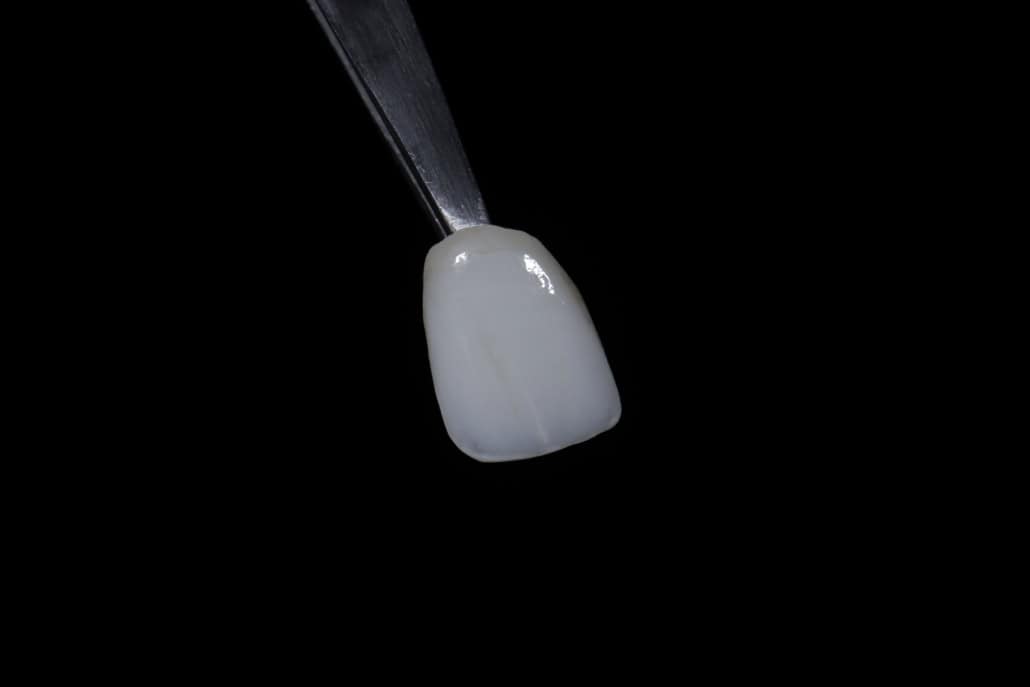 3D Printed dental Crown