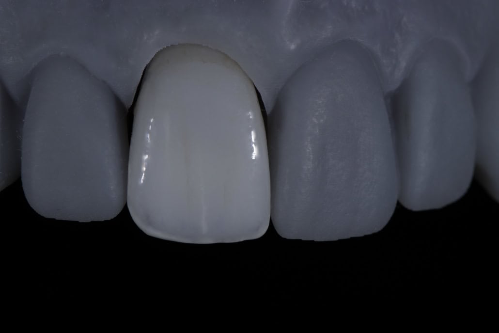 3D Printed crown laying on a printed dental model