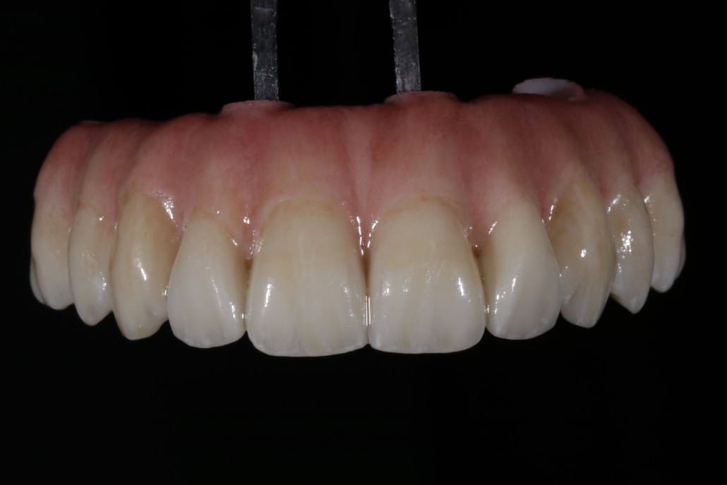 Polished 3D printed All-on-X Implant