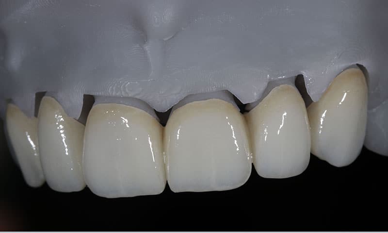 3D printed provisional application