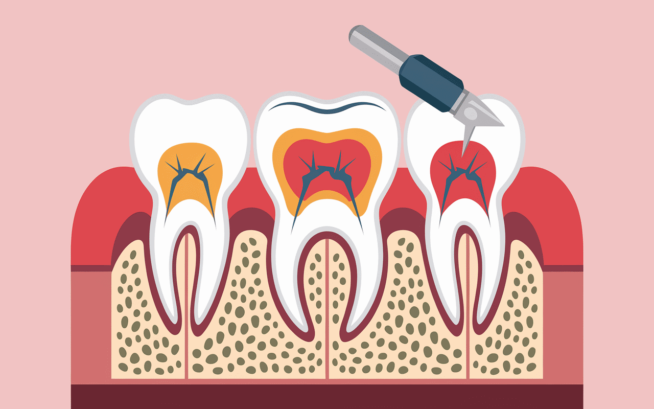 Dent cassée urgence niveaux de fracture illustration