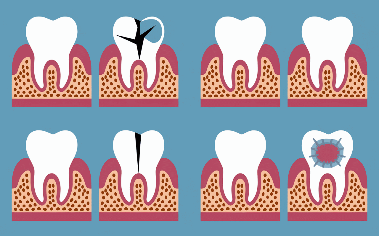 Quatre cas pansement dentaire illustration